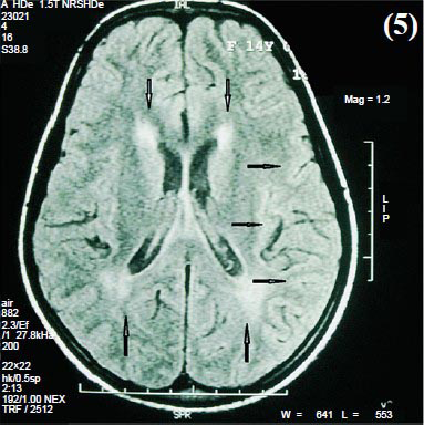 White matter hyper intensity involving both posterior periventricular and left frontotemporoparietal lobes (arrows) - Sequelae of encephalomyelitis.