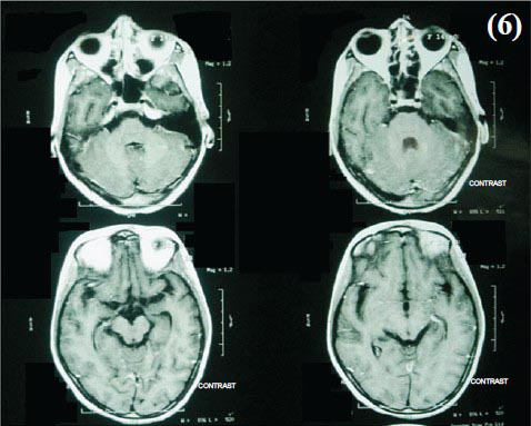 No abnormal parenchymal and meningeal enhancement was noted.