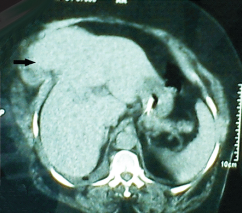 CT abdomen showing herniation of left lobe of the liver (arrow) through the epigastric region predominantly on the right side.