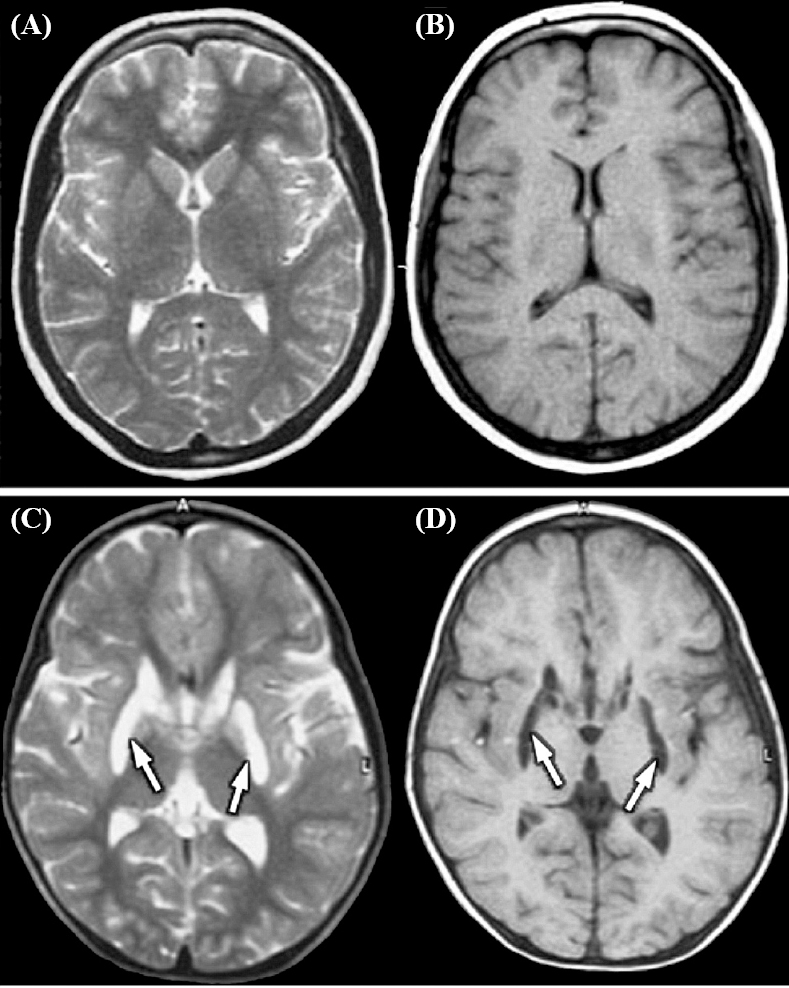 (A) T2-weighted magnetic resonance (MR) images of a normal child, and (B) Axial T1, and (C) T2- weighted MR images of the patient showing bilateral basal ganglionic lesions, highly characteristic of Leigh disease (shown by arrows), and (D) Axial T1. Source: Ref. 77.