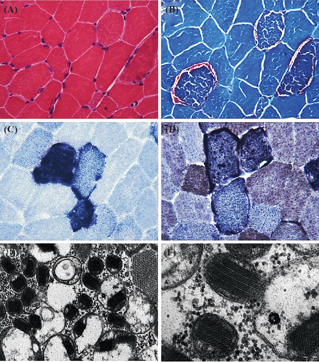 Tissue section showing the pathological abnormalities of mitochondrial disorders. (A) Hematoxylin and Eosin (HE) stain; (B) Red ragged fibers appear on modified gomorie trichome (MGT) stain suggesting abnormal subsarcolemmal accumulation of mitochondria; (C) Blue red fibers on succinate dehydrogenase (SDH) staining, suggesting an increased number of mitochondria; (D) COX staining shows absence of enzymes of respiratory chain. (E & F) Electron micrograph showing low and high magnification of mitochondria with paracrystalline inclusions (E x10000, F x40000).