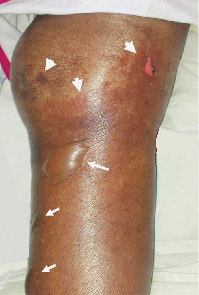 Photograph showing non-blanchable, purple coloured skin lesions with well defined margins (arrow heads) along with bullae (arrows) containing clear fluid suggestive of infectious purpura fulminans.