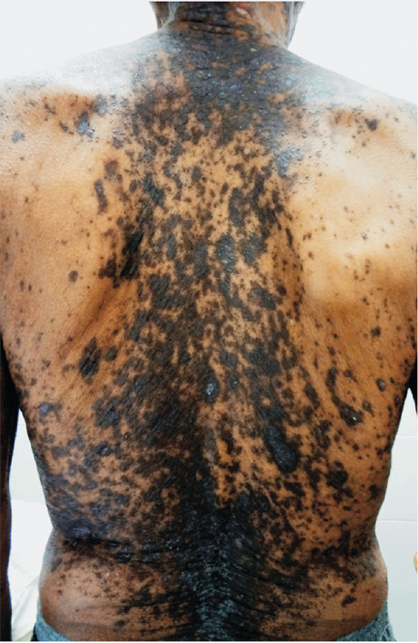 Violaceous, mildly scaly, discrete to confluent papules and plaque over the back.