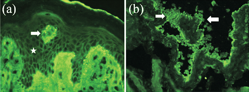 (a). Direct immunofluorescence of perilesional skin section showing IgG deposits on cell surface (star) and basement membrane zone (arrow). The arrow (→) points to a obliquely cut dermal papillae. (b). Indirect immunofluorescence of rat bladder section, showing positive IgG reactivity with the transitional epithelium over 1:10 titre (both arrows) 400x.