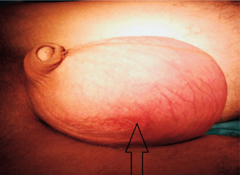 Giant testicular mass on phsycial examination (arrow).