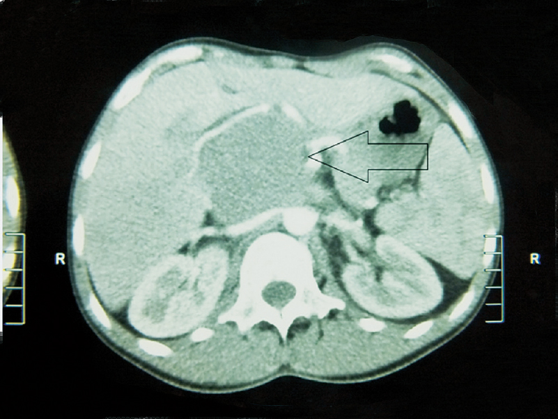 Computerized tomography of retroperitoneal lymphadenopathy. Arrow shows 10 ×9 cm mass.