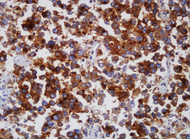 The tumour cells with cytoplasmic and perinuclear “dot-like” staining with podoplanin (×40).
