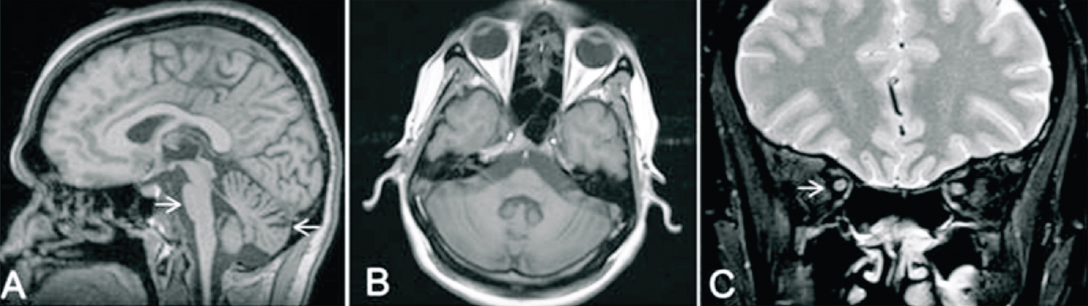 Findings of MRI brain of a patient AT1319 (CAG)48 Saggital (A) and axial (B) reconstructed 3D-MPRAGE (magnetization-prepared rapid gradient-echo) images of brain showing flattening of anterior belly of pons suggesting pontine atrophy (shown by arrows) and prominent cerebellar folia suggest cerebellar atrophy. Coronal T2-W1 of orbit (C) shows no evidence of optic nerve atrophy (shown by arrows).