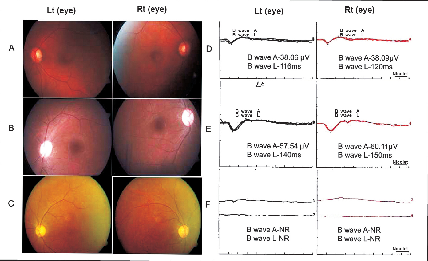 Fundus images and electroretinography (ERG) tracing of representative patients. Fundus showing (A) AT1795 case (CAG)43; bilateral fine mottling of retinal pigmentary epithelium (RPE), (B) AT1839(CAG)54; essential normal appearing fundus both eyes, (C) AT236 (CAG)49; macular atrophy and mild retinal arterial attenuation. ERG recording- (D) AT1795; B wave amplitude (A, μV) reduction RE/LE (38.09/38.06), latencies (L, milliseconds) RE/LE (120/116), (E) AT1839; B wave amplitude normal in RE and mildly reduced in LE (57.54), latencies RE/LE (140/150), (F) AT236; Extinguished response in both eyes.