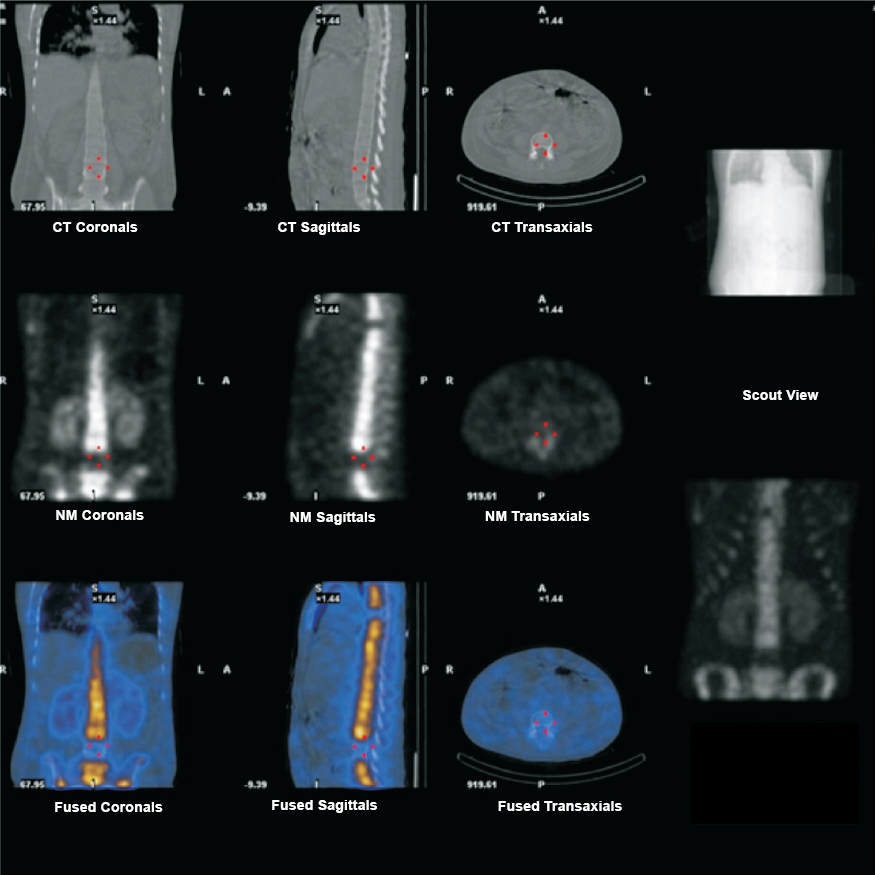 99mTC MDP bone SPECT CT (single photon emission computed tomography - computed tomography) images of dorsolumbar vertebrae showing cold defects in D6 and L4 vertebral bodies.