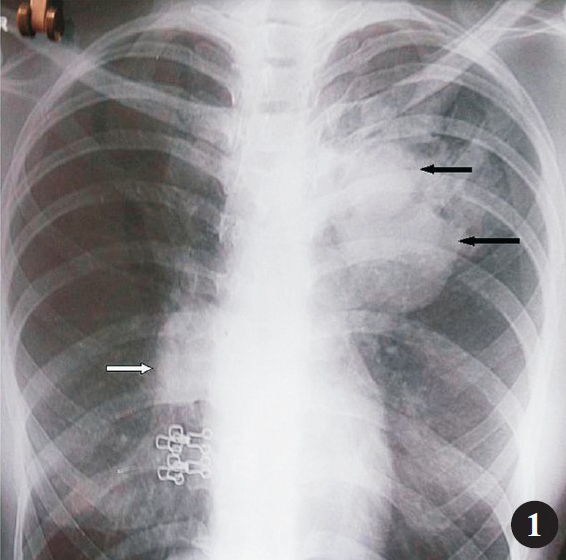 Chest radiograph (postero-anterior view) showing superimposed mass like lesions in the left upper and mid zones (black arrows) and smaller mass lesion in the right hilar area (white arrow).