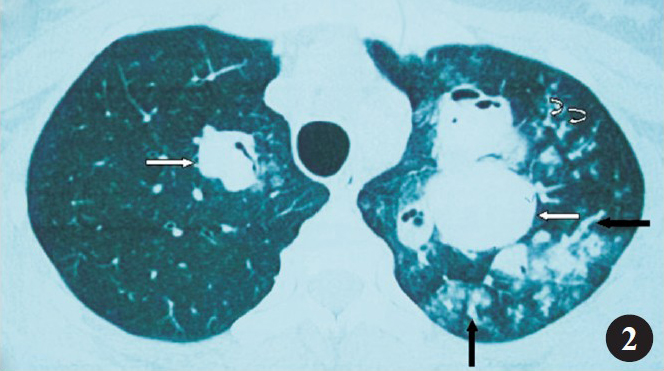 High resolution cuts at contrast enhanced chest tomography showing saccular (white arrows) to varicose (black arrows) central bronchiectasis, with the surrounding lung showing air spaces with nodules with tree in bud appearance (curved arrows) suggestive of transbronchial spread of infection.