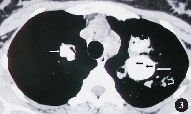 Non contrast chest tomography showing saccular (white arrows) to varicose (curved arrows) central bronchiectasis with hyperattenuating mucus (black arrow).