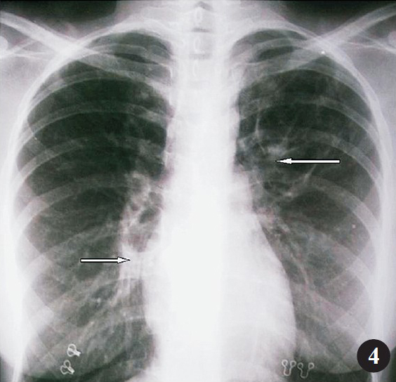 Chest radiograph (postero-anterior view) after three months of treatment revealing near complete resolution of mass like lesions (white arrows).