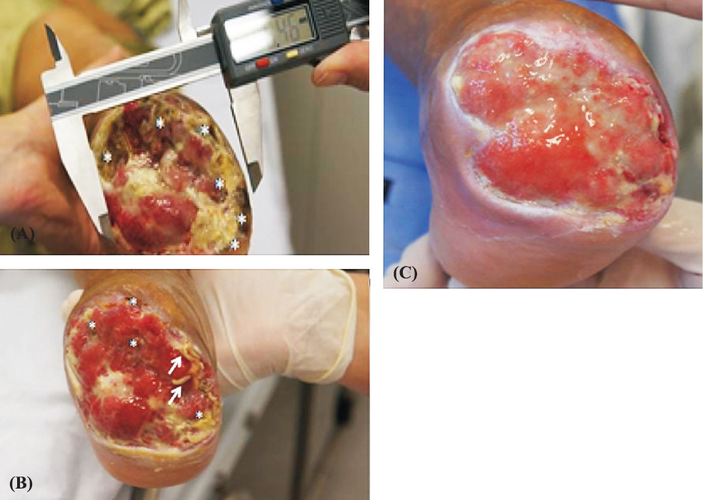 Patient's foot ulcer before and after the maggot therapy. (A). Measurement of the extent of necrosis and application of treatment (day 1). Asterisks represent areas of tissue necrosis. (B). Patient's foot ulcer image during treatment with maggot therapy (day 14). The asterisks represent areas of tissue necrosis and the arrows indicate the larvae of Chrysomya megacephala. (C). Patient's foot ulcer image after treatment with maggot therapy (day 43).