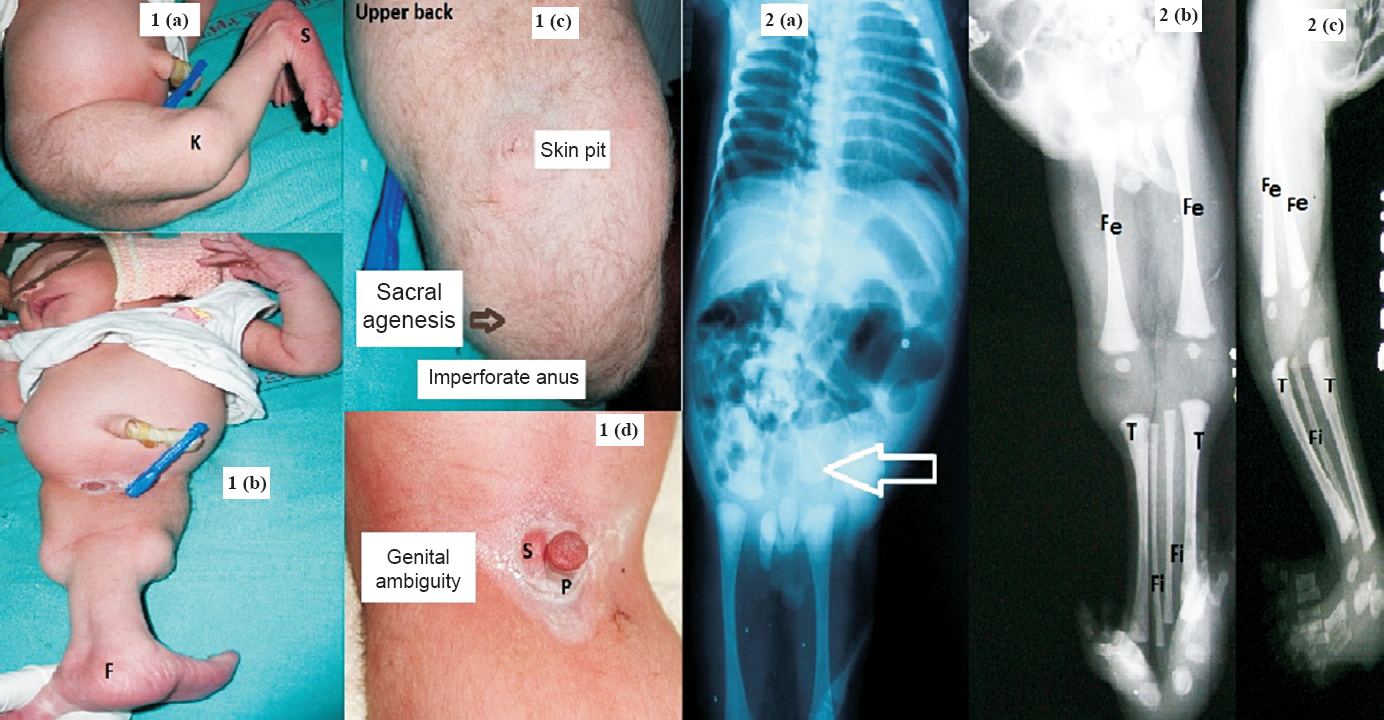 (a) photograph showing abnormal flexion of knees (K) with anteriorly placed soles (S). (b) photograph showing abnormal fusion of lower limbs from perineum to ankle with medial joining of two feet (F) (c) Posterior view showing flat perineum (black arrow) with imperforate anus and lumbosacral dermal pit. (d) photograph showing a rudimentary phallus (P) with no urethral opening and dorsally placed hemiscrotum (S). Fig. 2 (a). Anterioposterior (AP) radiography view of abdomen showing sacral agenesis (white arrow), kyphoscoliosis. (b), (c) AP and lateral views of lower limbs showing separate femur (Fe), tibia (T) with abnormal medial position of fibula (Fi).