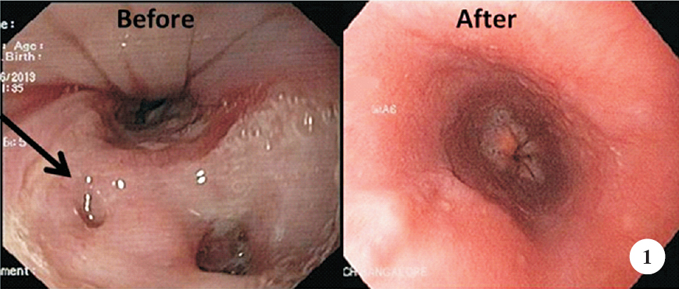 Endoscopy showing a linear clean based ulcer with undermined edges and fistulous opening in the mid oesophagus (arrow) before treatment and a later image showing completely healed ulcer.