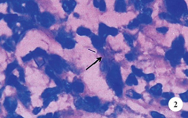 Histopathology of oesophageal ulcer biopsy with Ziehl-Neelsen stain showing (arrow) acid fast bacilli (100 x).