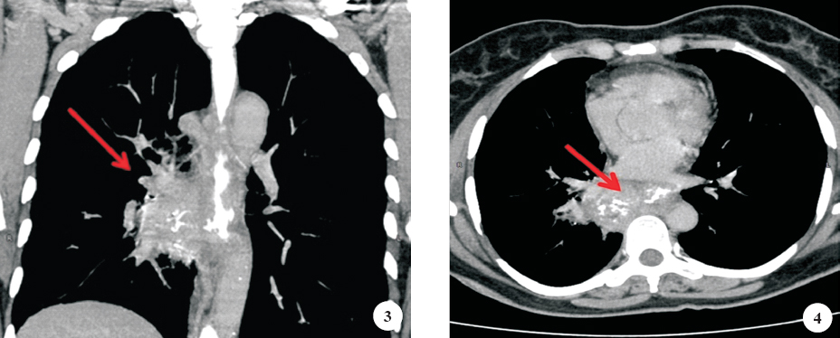 CT scans showing (arrow) well-defined enhancing mid paraesophageal lesion with evidence of a fistulous tract between the oesophagus and right mid paraesophageal irregular cavity.