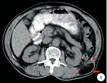 The computed tomography of abdomen showed retroperitoneal fat protruding through Grynfeltt's triangle (bold red arrow) bound by the 12th rib superiorly (thin red arrow), the quadratus lumborum muscle medially (triangle), and internal oblique muscle laterally (asterisk).