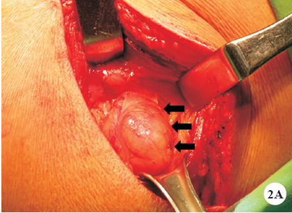 The operation demonstrated a soft, tympanic and compressible herniated sac with a smooth surface (arrows).