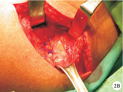 The defect was repaired by direct apposition of the internal oblique muscle and fascia with non-absorbable sutures.