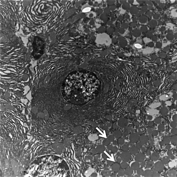 Electron microscopy showing dense core secretory granules (arrow) indicating endocrine differentiation (10000X).