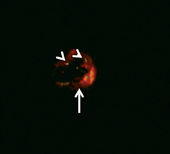Immunofluorescence on pancreatic islet tissue showing double staining of MSCs with BrdU (green in colour and depicted as arrow head) and insulin (red in colour and depicted as arrow) in the experimental study group (20X).
