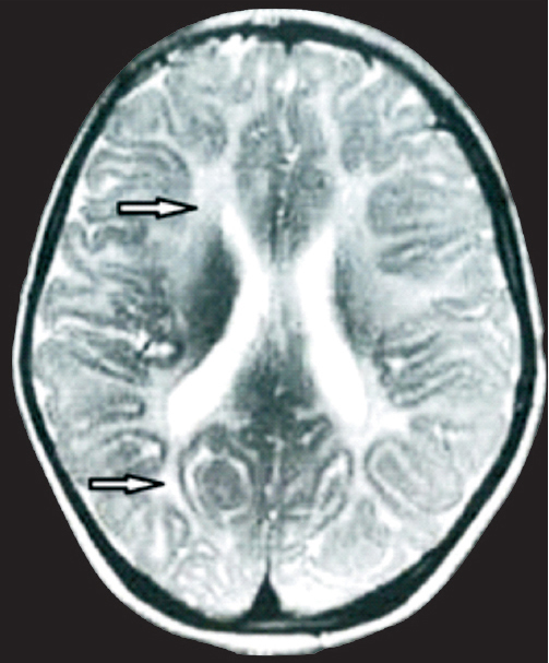 MRI image of patient A showing extensive leukodystrophy in frontal and occipital white matter (arrow).