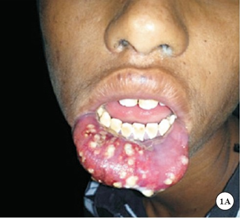 (A)Photograph of the patient showing oedematous everted lower lip with a few pustules and multiple coalescing to discrete ulcers.