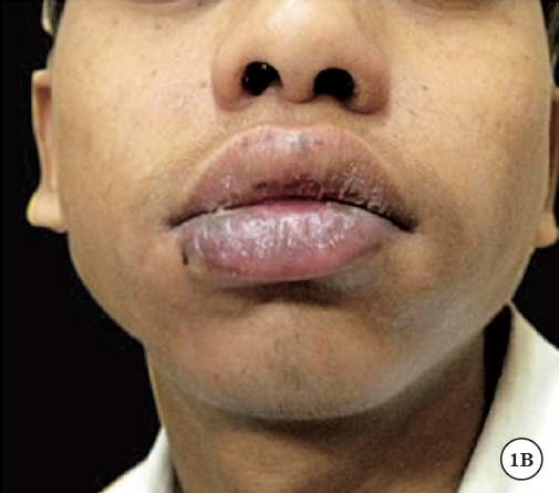 (B)Marked improvement in erosions and swelling after one week of acyclovir therapy.