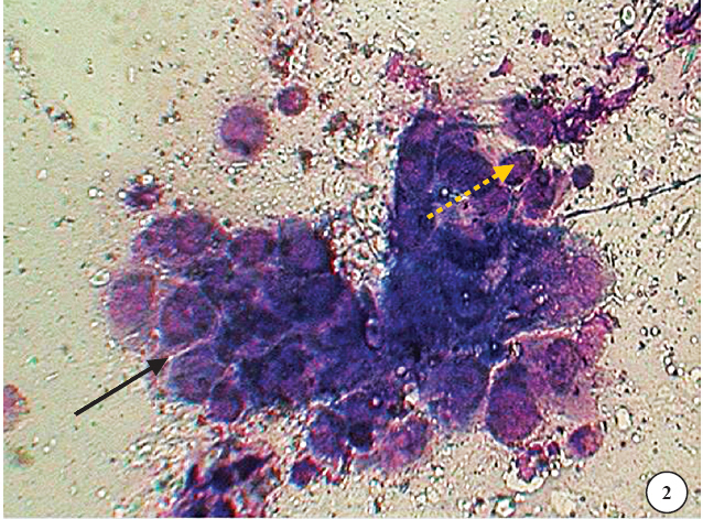 Tzank smear made from the base of lesion showing multinucleate giant cell (black arrow) and a few secondary acantholytic cells (dotted arrow) at periphery (oil immersion field) × 100.