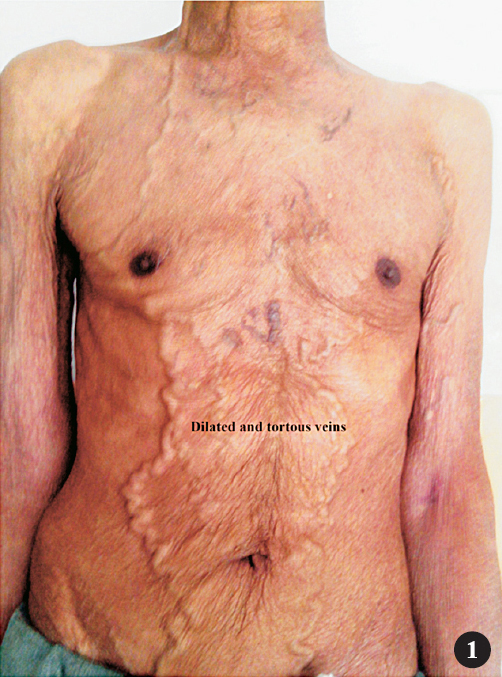 Dilated and tortuous veins on chest and abdomen.