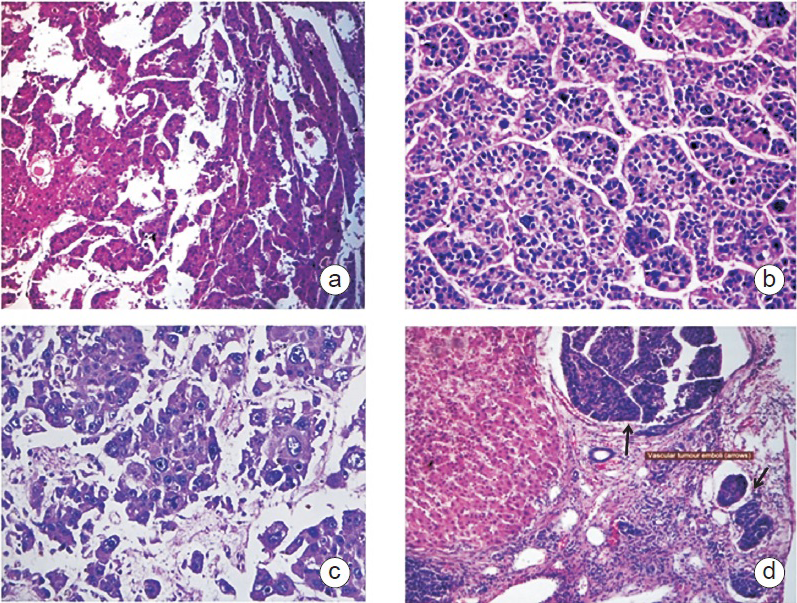 Hepatocellular carcinoma. (a) Well differentiated, H&E 100X, (b) Moderately differentiated, H&E 200X, (c) Poorly differentiated H&E 200X (d) Microvascular invasion (arrows) H&E100X.