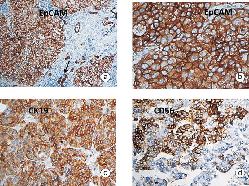a. Tumour cells and bile ductules (arrow-internal control) showing strong membranous staining for EpCAM, Immunohistochemistry100X. b. High power showing EpCAM positive tumour cells, Immunohistochemistry 400X. d. Tumour cells showing strong membranous staining for CK19, Immunohistochemistry100X. d. Tumour cells showing strong membranous staining for CD56, immunohistochemistry 400X.