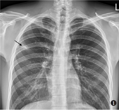 Posterior-anterior chest radiograph showing opacification over right upper lobe (arrow).