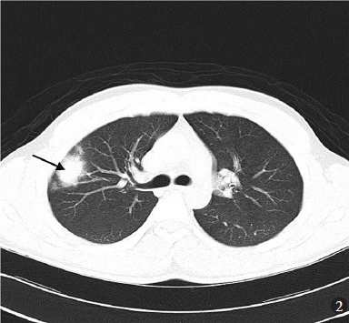 Non-enhanced computed tomography demonstrated a 25mm nodule in the right upper lobe (arrow).
