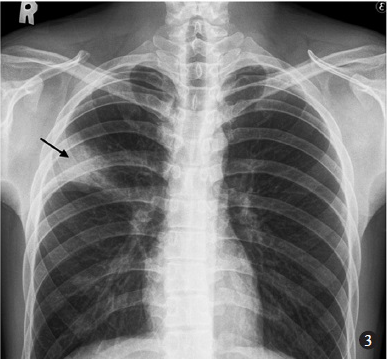 Chest radiograph obtained 5 days later revealed a consolidation in the right upper lobe (arrow).
