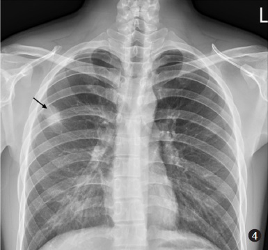 Repeat chest radiograph after 14 days showed regression of air-space opacification over right upper lobe (arrow).