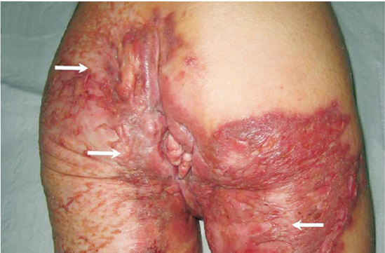 Large and erythematous-brownish plaques with a granulomatous appearance on the perineal, perianal and gluteal regions reaching the top of the lower limbs (arrows).