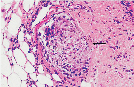 Histological study (hematoxilin and eosin stain) showed the presence of non-caseating granulomas in the dermis (arrow).