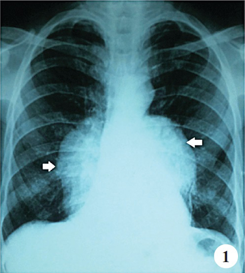Chest X-ray posterior anterior (PA) view shows bilateral well defined smooth convex outline radio-opacity seen in lower thoracic paraspinal area extending below the margin of diaphragm (white arrows)