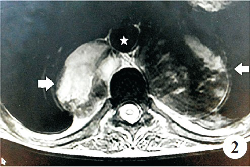 MRI scan T2 weighted of thorax showing bilateral paraspinal mass lesions without intraspinal extension (white arrows). Aorta (marked by asterisk) is lifted away from the spine by the mass