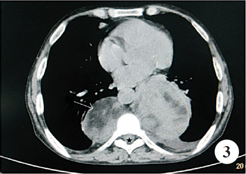 Axial non-contrast computed tomography of the chest demonstrates fat withing the parasinal mass (marked by long arrow)