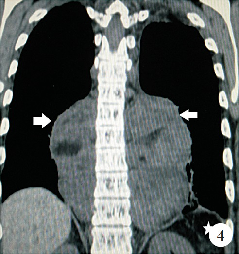 Coronal non-contrast computed tomography of the chest demonstrates paraspinal mass on either side (marked as white arrow). Spleen is not visualized in splenic fossa (marked as asterisk). Patient had undergone splenectomy earlier.