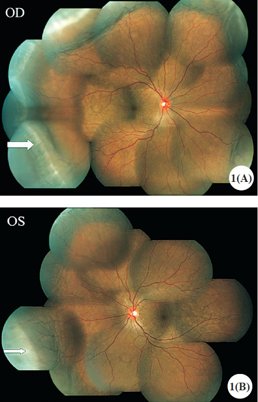 (A). Colour fundus montage image of right eye showing serous choroidal detachment. Ora serrata is visible (arrow). (B). Colour fundus montage image of left eye showing serous choroidal detachment. Ora serrata is visible (arrow)