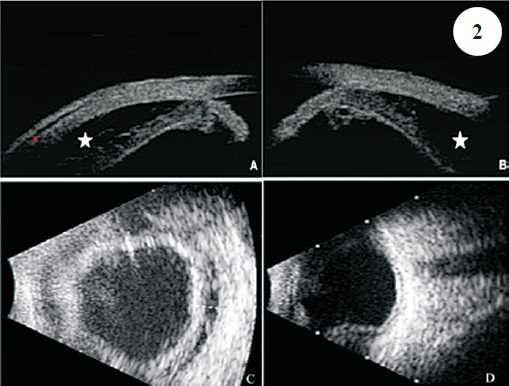(A, B) UBM images of both eyes revealing supraciliary effusion (asterisks). (C, D): Ultrasound images documenting 360° serous choroidal detachments