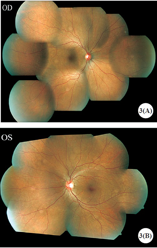 Post-treatment colour fundus montage image of right eye (A) and left eye (B) taken at one month follow up visit documenting resolution of choroidal detachments