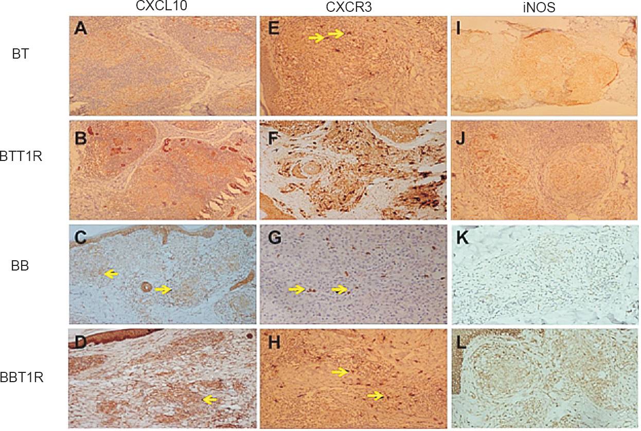 Immunohistochemical expression of CXCL10, (A-D), CXCR3 (E-H) and i-NOS (I-L) in borderline leprosy biopsies with and without reaction. BT, borderline tuberculoid leprosy; BB, mid borderline leprosy; BL, borderline lepromatous leprosy.