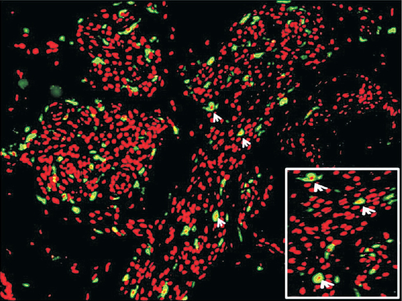 Immunofluorescent staining in leprosy patients with T1R showing localization of CXCR3 on the cell membrane (inset, arrows).